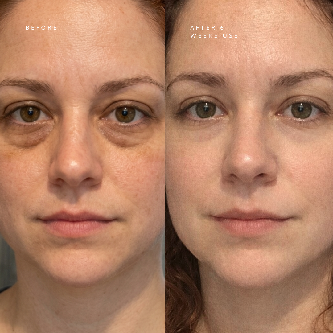 Under Eye Rejuvenation Tool Med Rødt Lys Teknologi Og EMS Dual Tech
