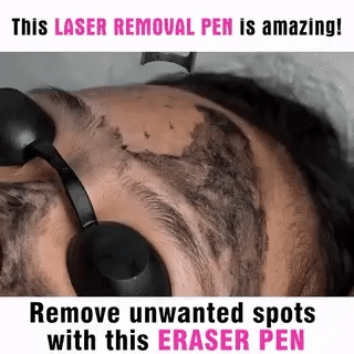 AstraGlow Kompakt Laser Pen Til Fjernelse Af Tattoos, Modermærker Og Frækner